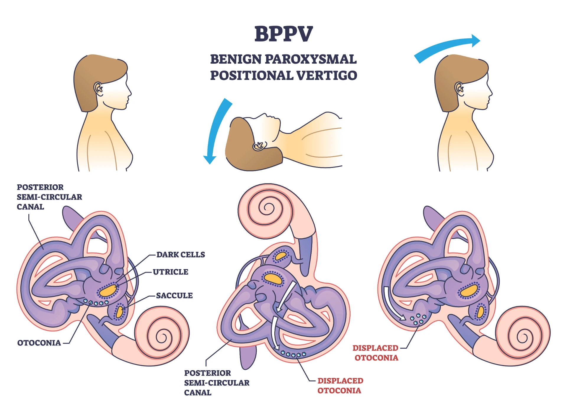 BPPV inner ear illustration showing displaced otoconia in the semicircular canal
