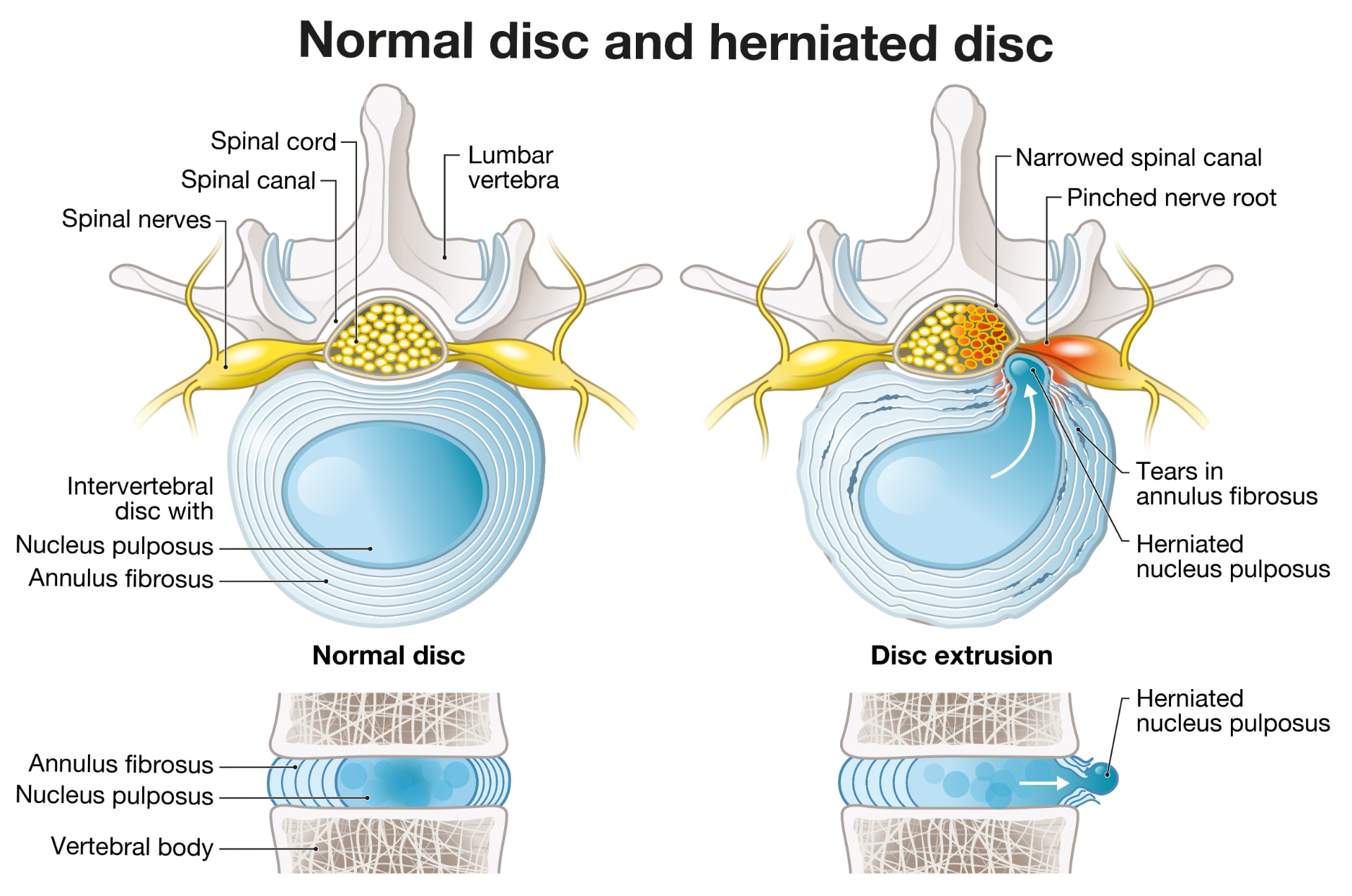 Medical illustration comparing a normal spinal disc with a herniated disc affecting a nearby spinal nerve root