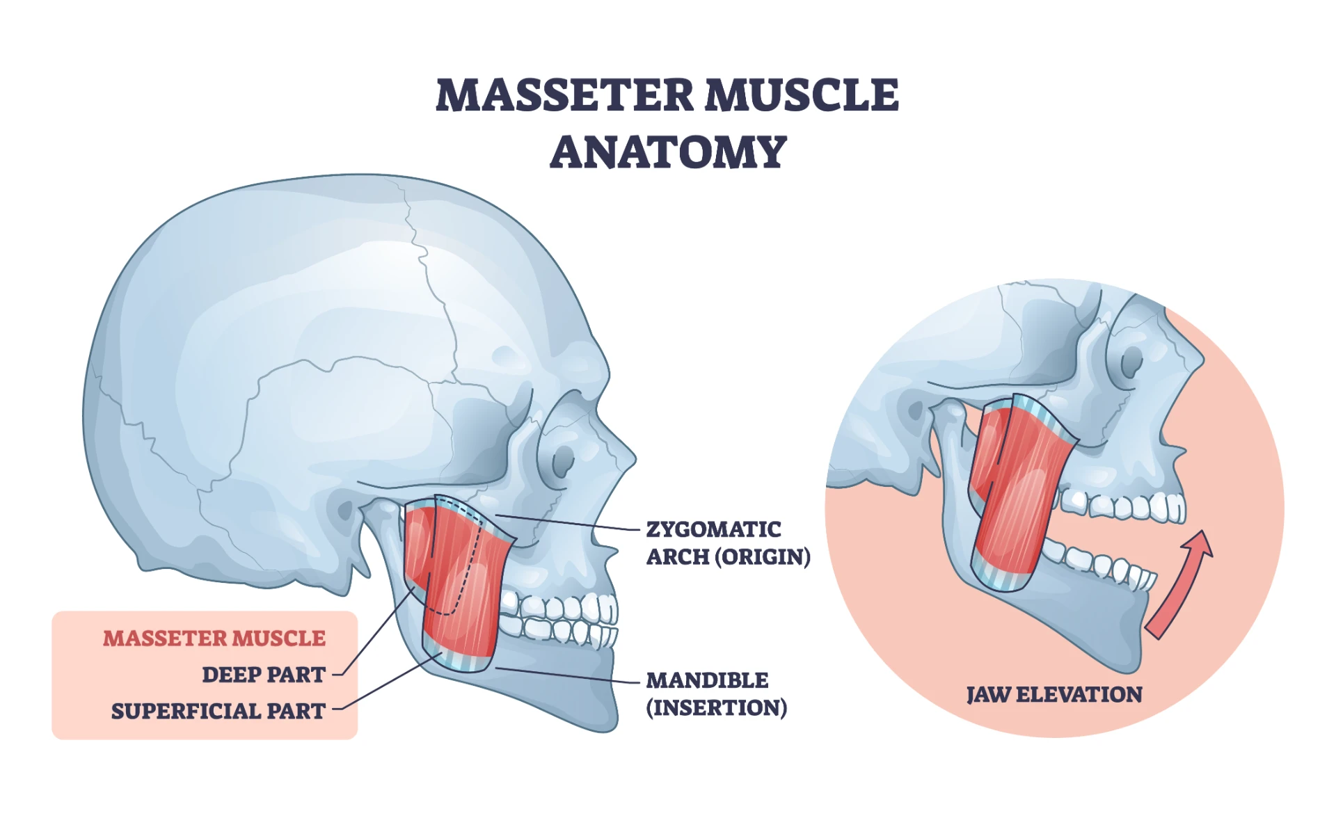 Anatomy diagram of the masseter muscle running from the zygomatic arch to the mandible, beside the temporomandibular joint in front of the ear, with an inset showing jaw elevation