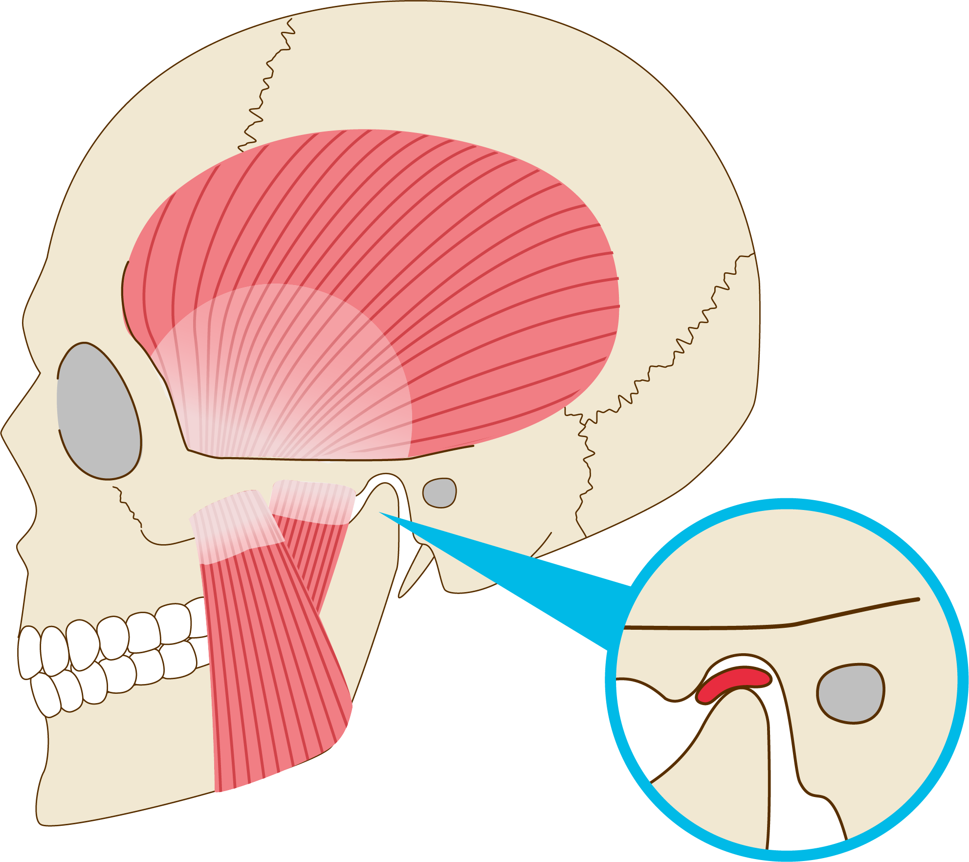 Illustration of the jaw muscles with a close-up of the temporomandibular joint showing the articular disc between the mandible and the skull