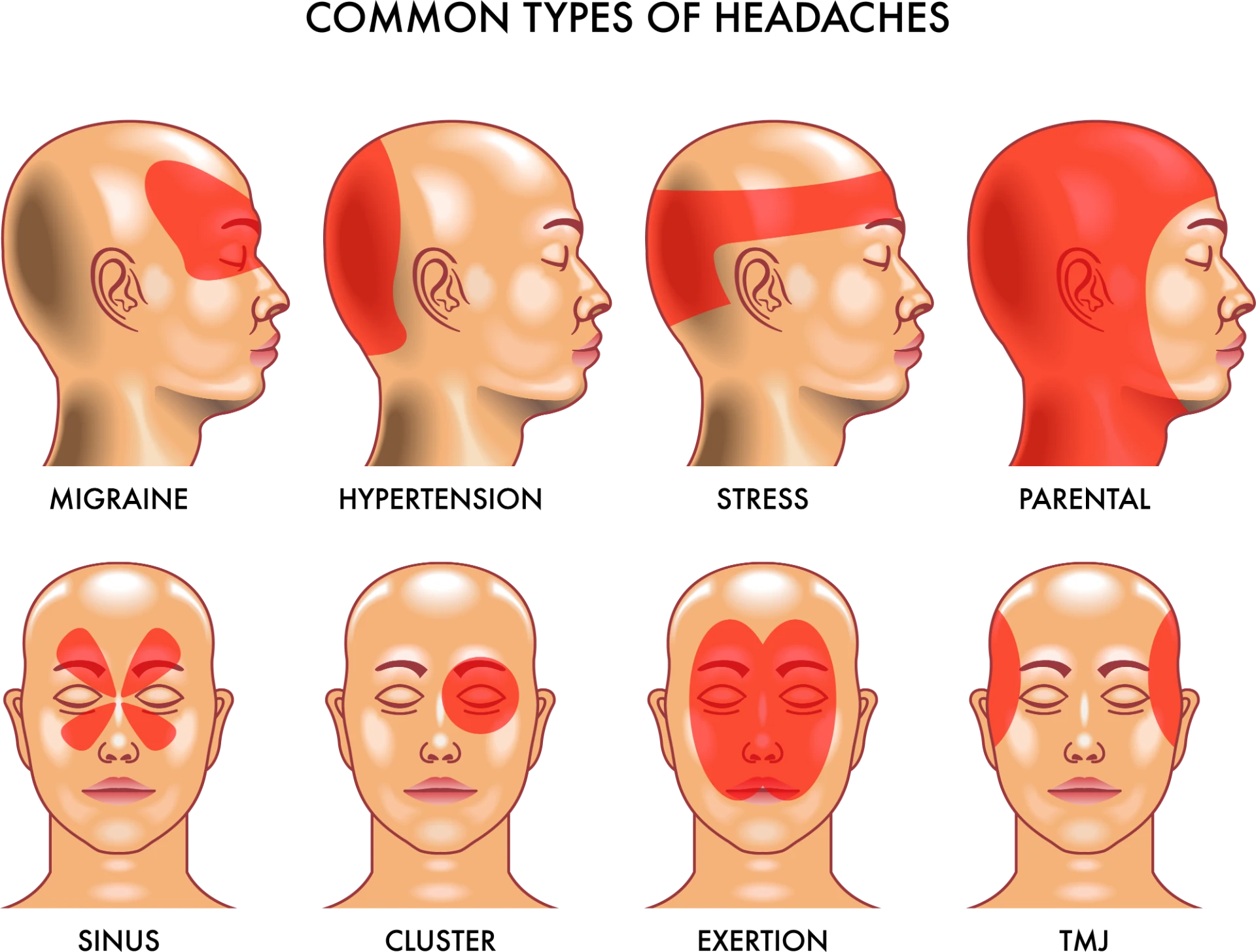 Illustration showing different patterns and locations of headache pain around the head.